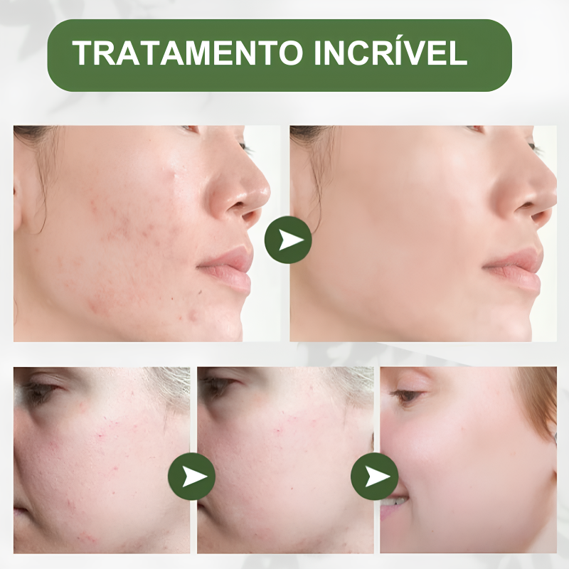 Hidratante Facial que Remove Acnes e Renova a Pele